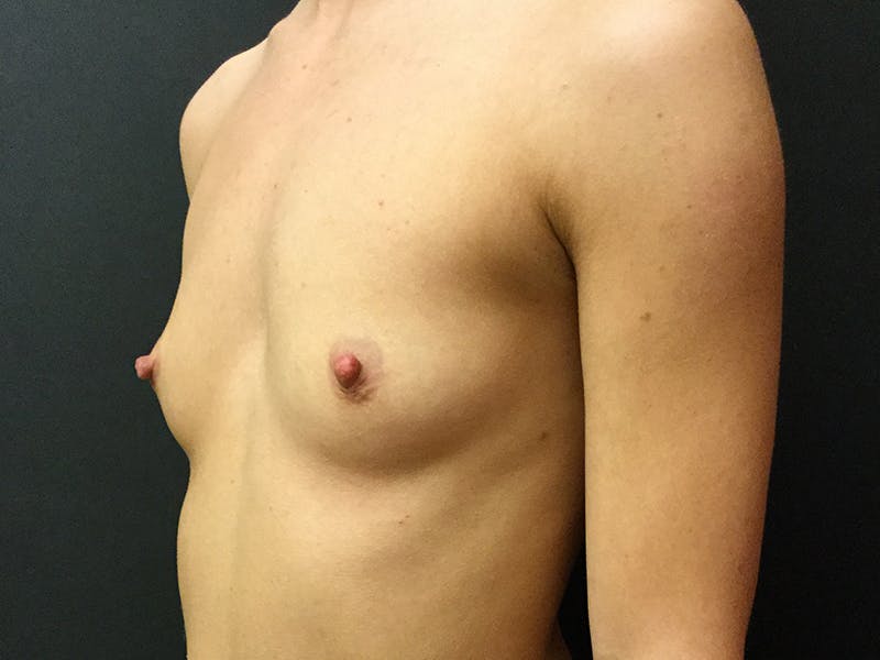 Breast Augmentation Before & After Gallery - Patient 109479459 - Image 3
