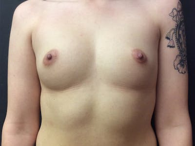 Breast Augmentation Before & After Gallery - Patient 109483083 - Image 1