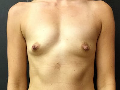 Breast Augmentation Before & After Gallery - Patient 109483085 - Image 1