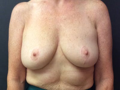 Breast Augmentation Before & After Gallery - Patient 109483188 - Image 1