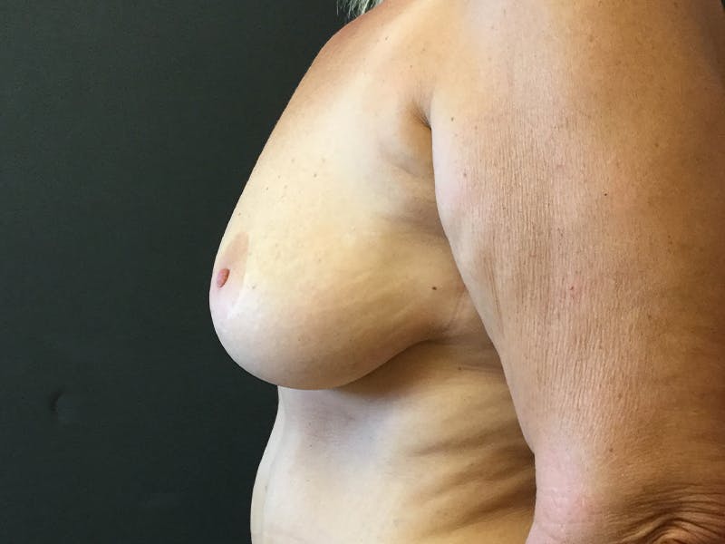 Breast Lift Before & After Gallery - Patient 109483191 - Image 3