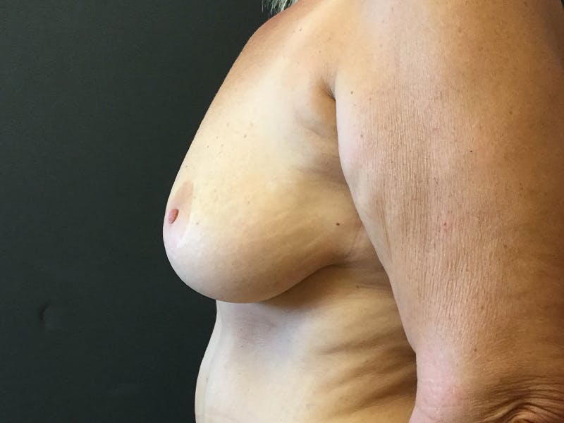 Breast Augmentation Before & After Gallery - Patient 109483189 - Image 3