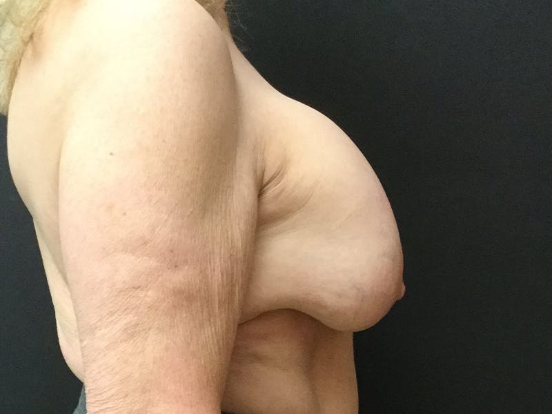 Breast Lift Before & After Gallery - Patient 109483192 - Image 3