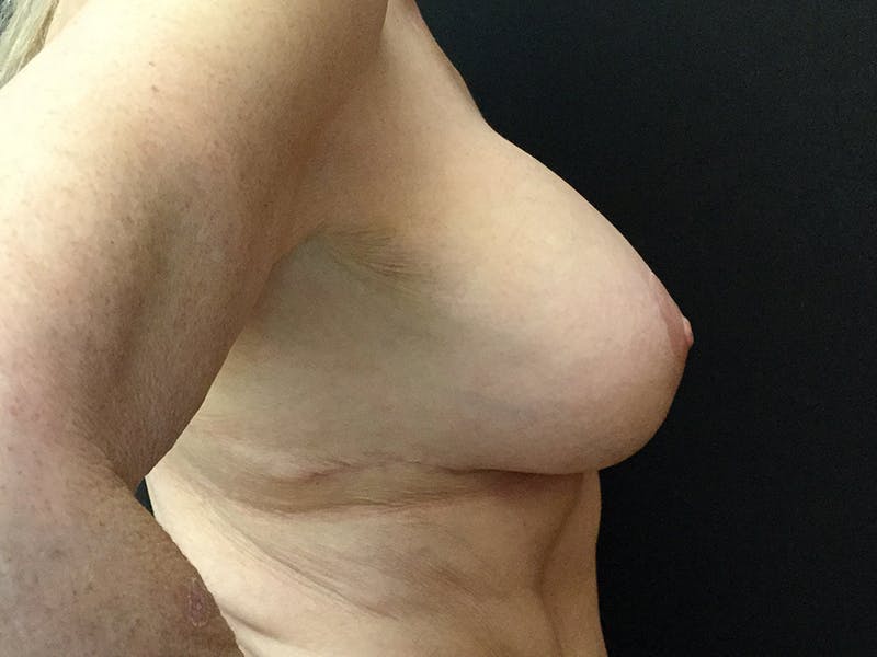 Breast Lift Before & After Gallery - Patient 109483192 - Image 4