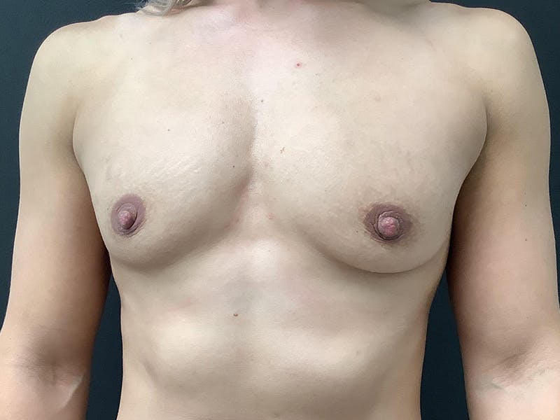 Breast Augmentation Before & After Gallery - Patient 112941731 - Image 1