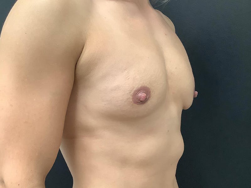 Breast Augmentation Before & After Gallery - Patient 112941731 - Image 3