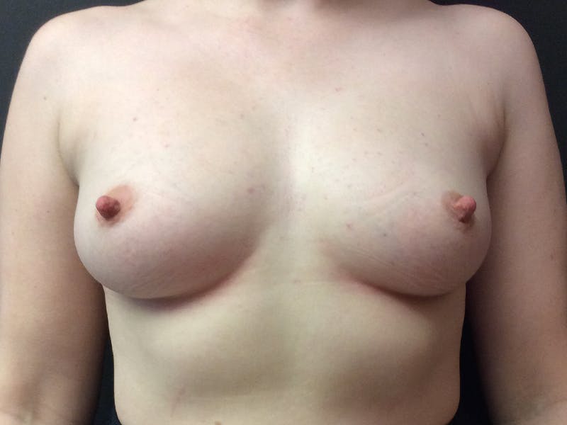 Breast Augmentation Before & After Gallery - Patient 112941757 - Image 1