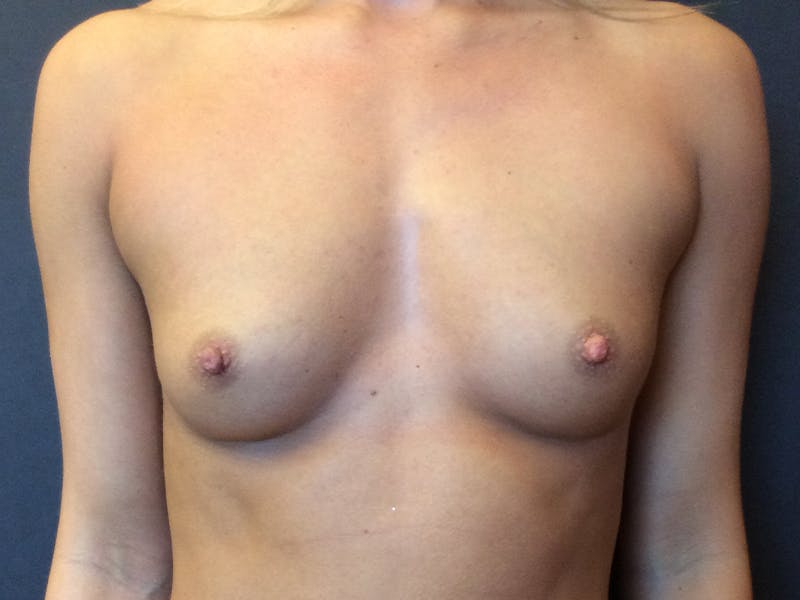 Breast Augmentation Gallery - Patient 112942052 - Image 1