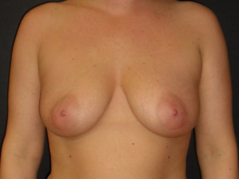 Breast Augmentation Before & After Gallery - Patient 112942181 - Image 1