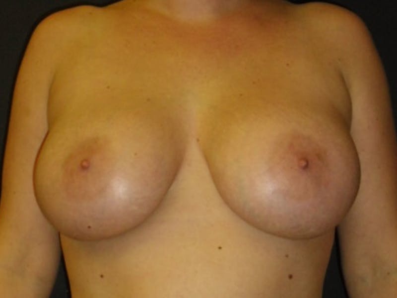 Breast Augmentation Before & After Gallery - Patient 112942181 - Image 2