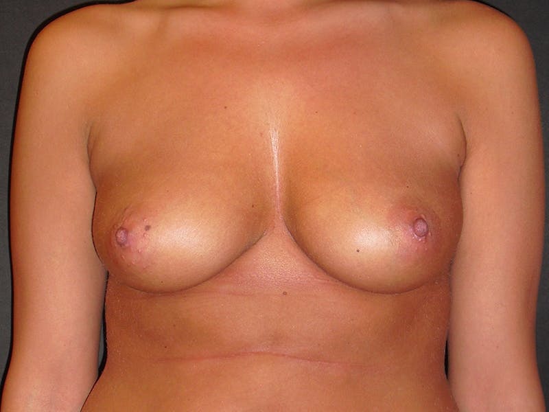 Breast Augmentation Gallery - Patient 112942224 - Image 1