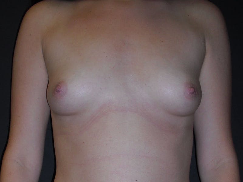 Breast Augmentation Gallery - Patient 112942994 - Image 1