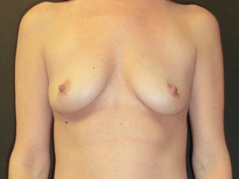 Breast Augmentation Before & After Gallery - Patient 112943144 - Image 1