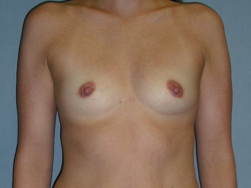 Breast Augmentation Gallery - Patient 112943145 - Image 1