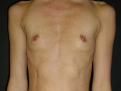 Breast Augmentation Before & After Gallery - Patient 112943609 - Image 1