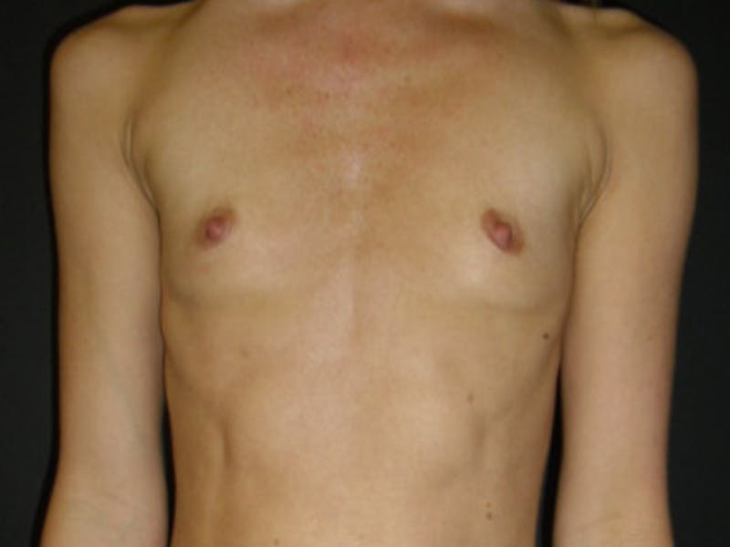 Breast Augmentation Gallery - Patient 112943609 - Image 1