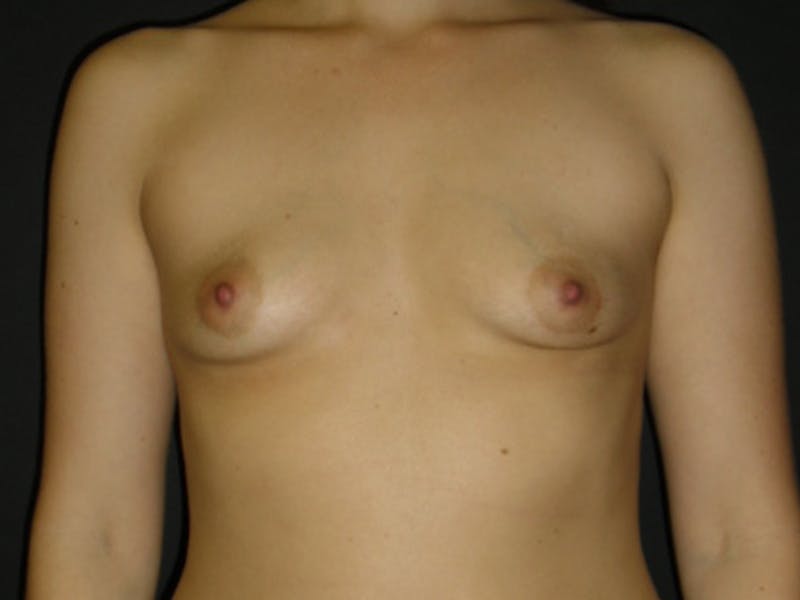 Breast Augmentation Before & After Gallery - Patient 112950111 - Image 1