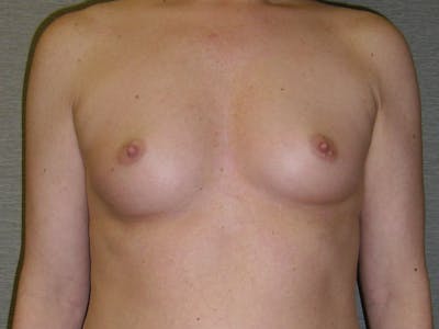 Breast Augmentation Before & After Gallery - Patient 112950160 - Image 1