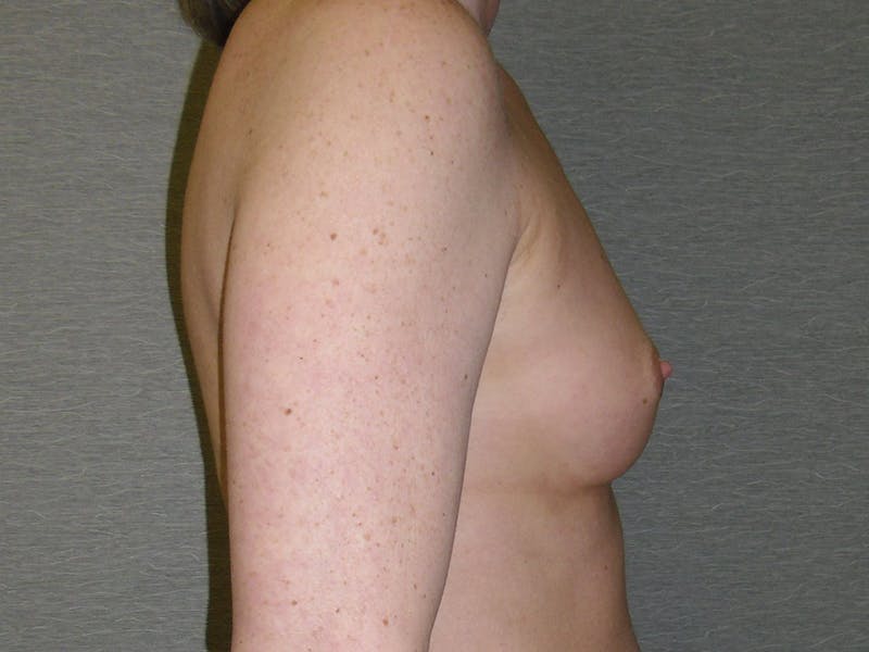 Breast Augmentation Gallery - Patient 112950160 - Image 3