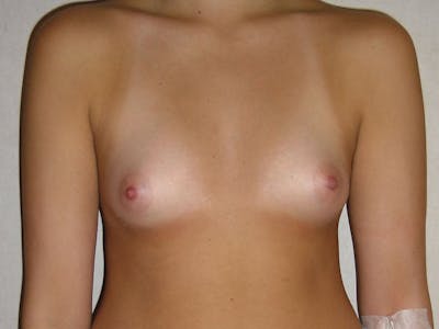 Breast Augmentation Before & After Gallery - Patient 112950181 - Image 1