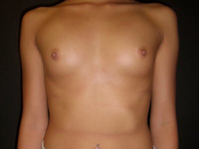 Breast Augmentation Before & After Gallery - Patient 112950370 - Image 1
