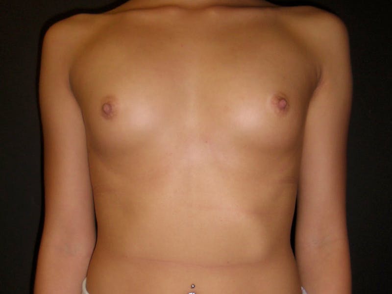 Breast Augmentation Before & After Gallery - Patient 112950370 - Image 1