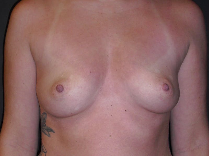 Breast Augmentation Before & After Gallery - Patient 112950415 - Image 1