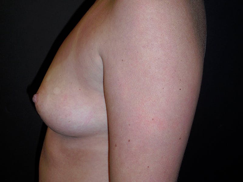 Breast Augmentation Before & After Gallery - Patient 112950415 - Image 3