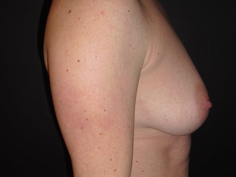 Breast Augmentation Gallery - Patient 112950427 - Image 3