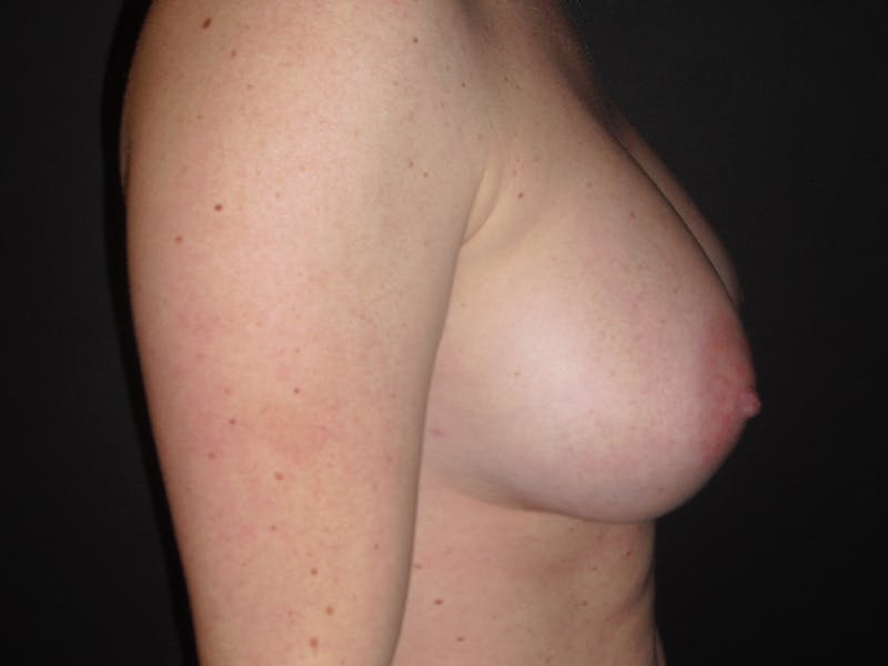 Breast Augmentation Gallery - Patient 112950427 - Image 4