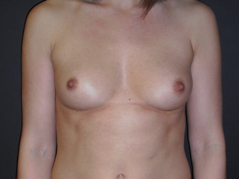 Breast Augmentation Before & After Gallery - Patient 112950434 - Image 1