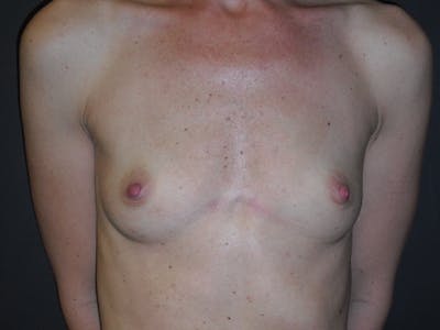 Breast Augmentation Before & After Gallery - Patient 112950519 - Image 1