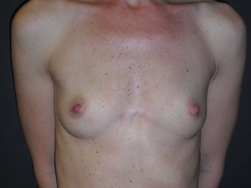 Breast Augmentation Gallery - Patient 112950519 - Image 1