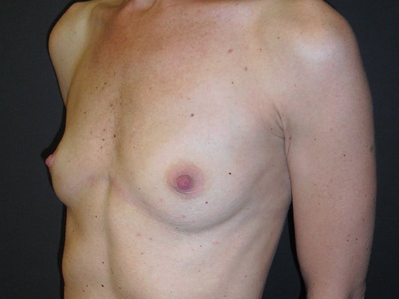 Breast Augmentation Gallery - Patient 112950519 - Image 3