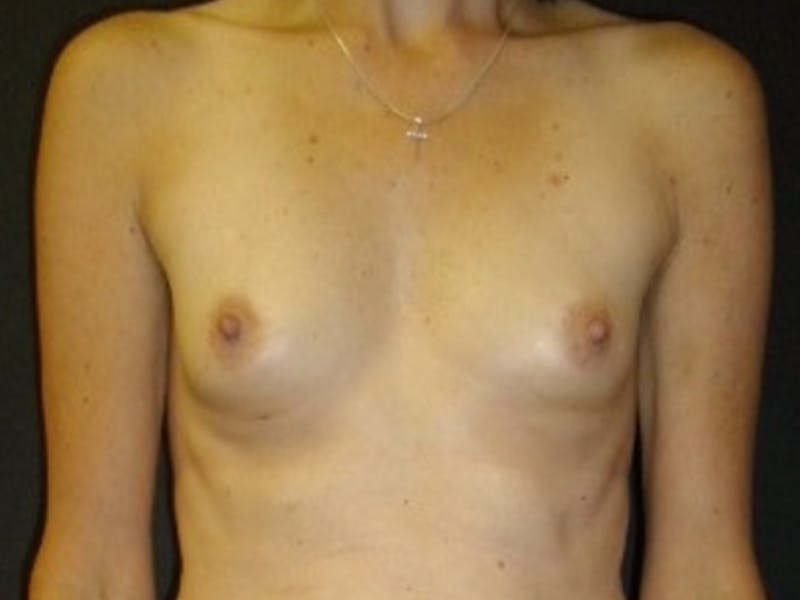 Breast Augmentation Gallery - Patient 112952237 - Image 1