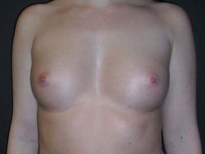 Breast Augmentation Before & After Gallery - Patient 112952272 - Image 1