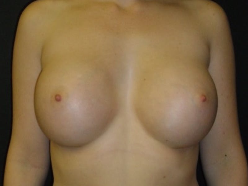 Breast Augmentation Gallery - Patient 112952272 - Image 2