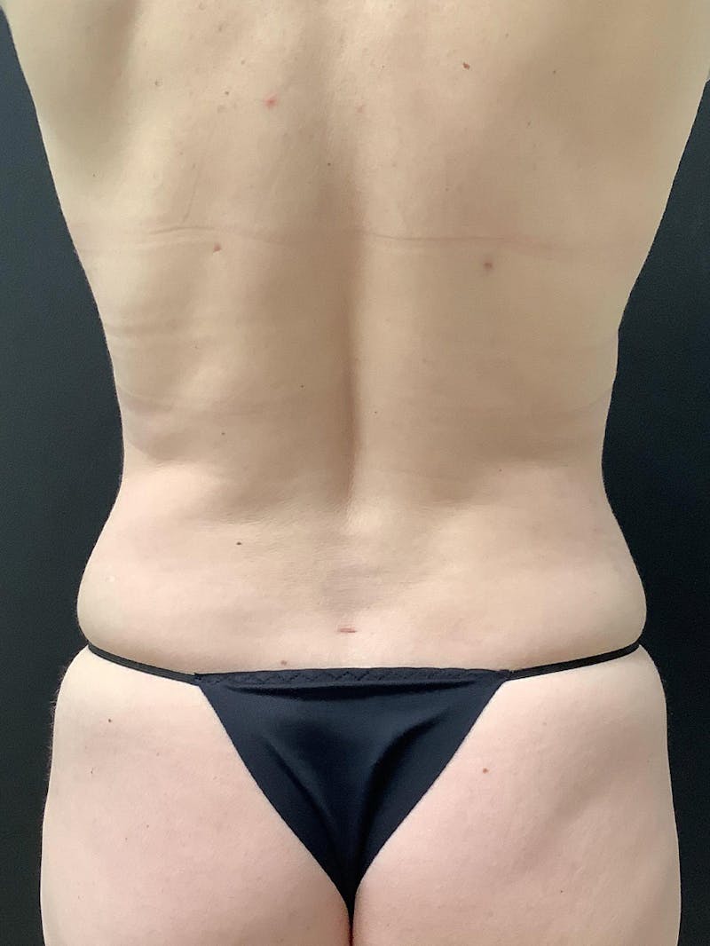 Liposuction Gallery - Patient 112966031 - Image 2