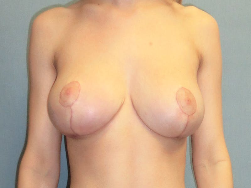 Breast Reduction Gallery - Patient 112966083 - Image 2