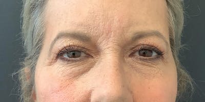 Eyelid Surgery Before & After Gallery - Patient 112966147 - Image 1