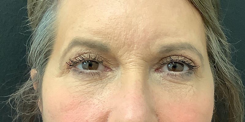 Eyelid Surgery Before & After Gallery - Patient 112966147 - Image 4