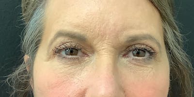 Eyelid Surgery Before & After Gallery - Patient 112966147 - Image 2