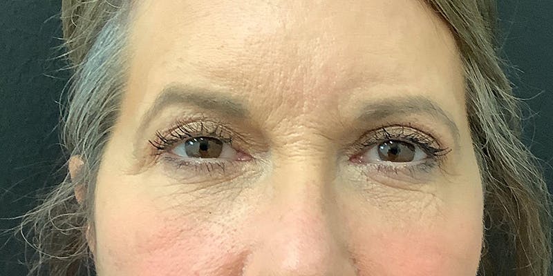 Eyelid Surgery Before & After Gallery - Patient 112966147 - Image 2