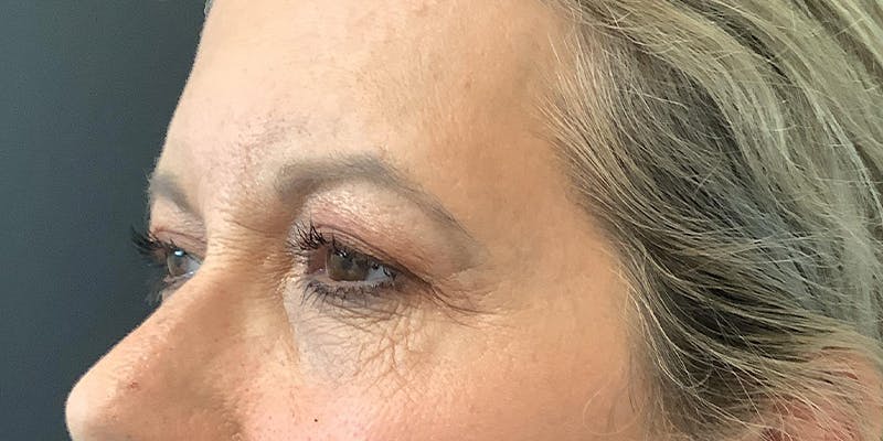 Eyelid Surgery Before & After Gallery - Patient 112966147 - Image 3