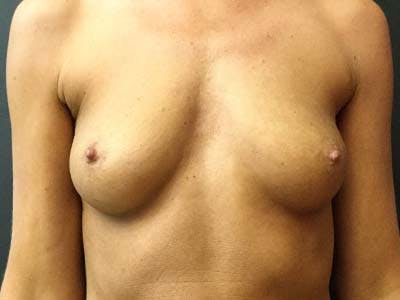 Breast Augmentation Before & After Gallery - Patient 122008199 - Image 1