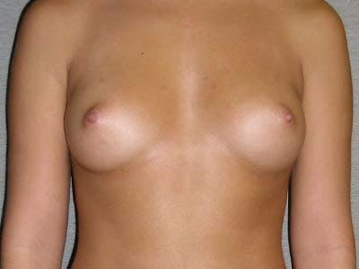 Breast Augmentation Before & After Gallery - Patient 122008195 - Image 1