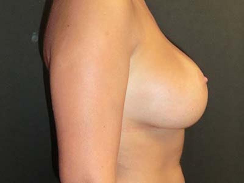 Breast Augmentation Before & After Gallery - Patient 122008195 - Image 4