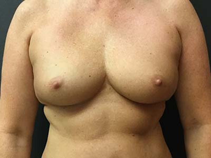 Breast Augmentation Before & After Gallery - Patient 122008192 - Image 1