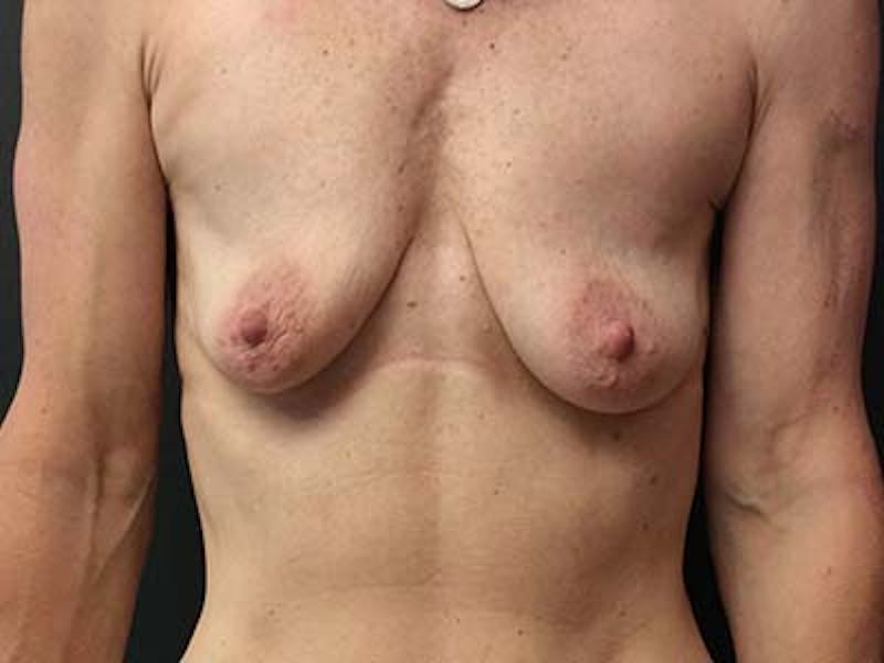 Breast Augmentation Before & After Gallery - Patient 122008191 - Image 1