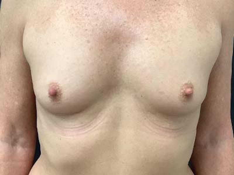 Breast Augmentation Before & After Gallery - Patient 122008189 - Image 1